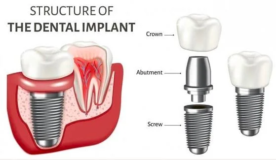 2.9 mm Different Prosthetic Connections Dental Isykone Implants